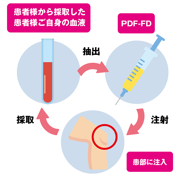 PDF-FD療法の流れ