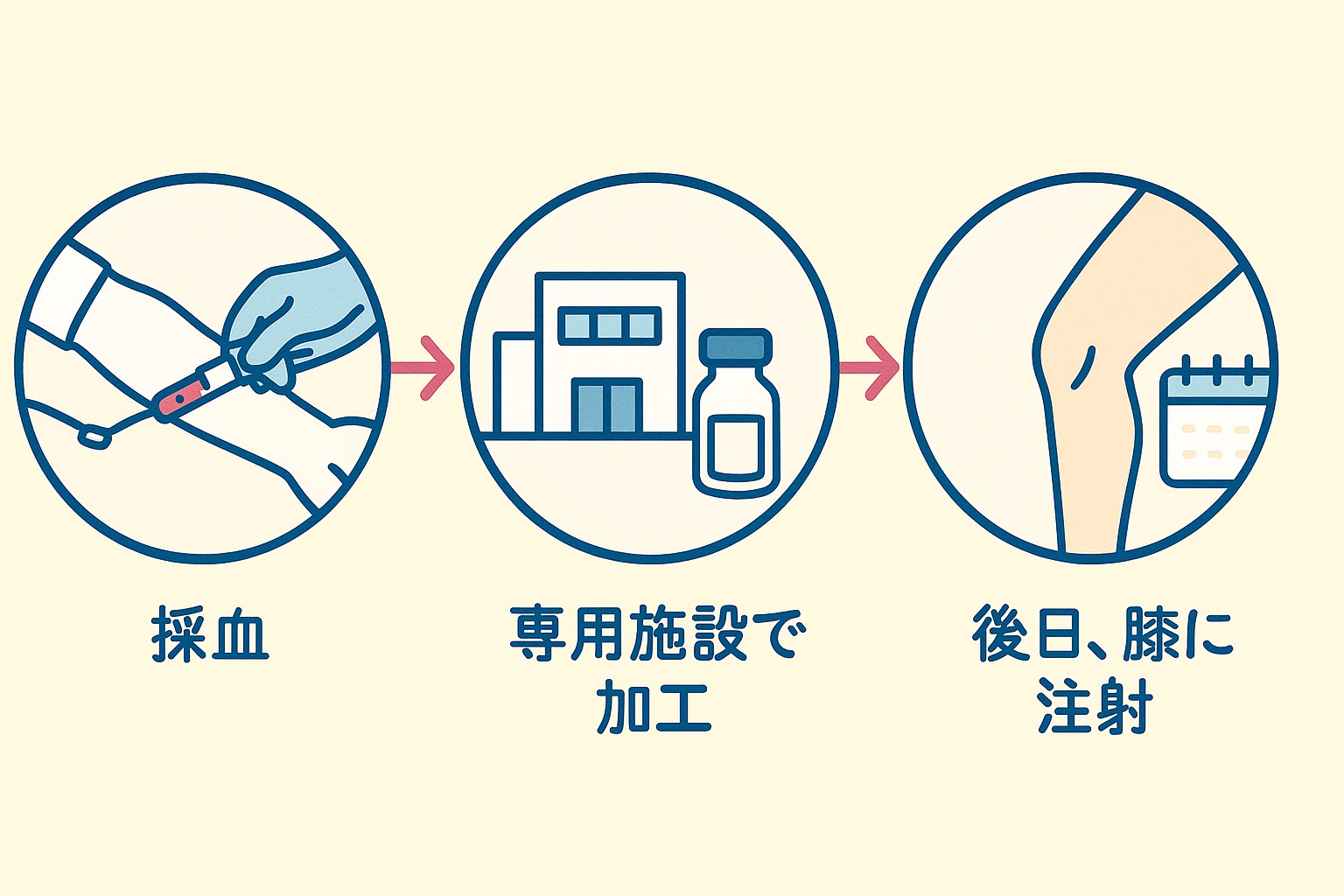 PFC-FD療法の流れを3つの段階で示した図。左から採血、専用施設で加工、後日膝に注射