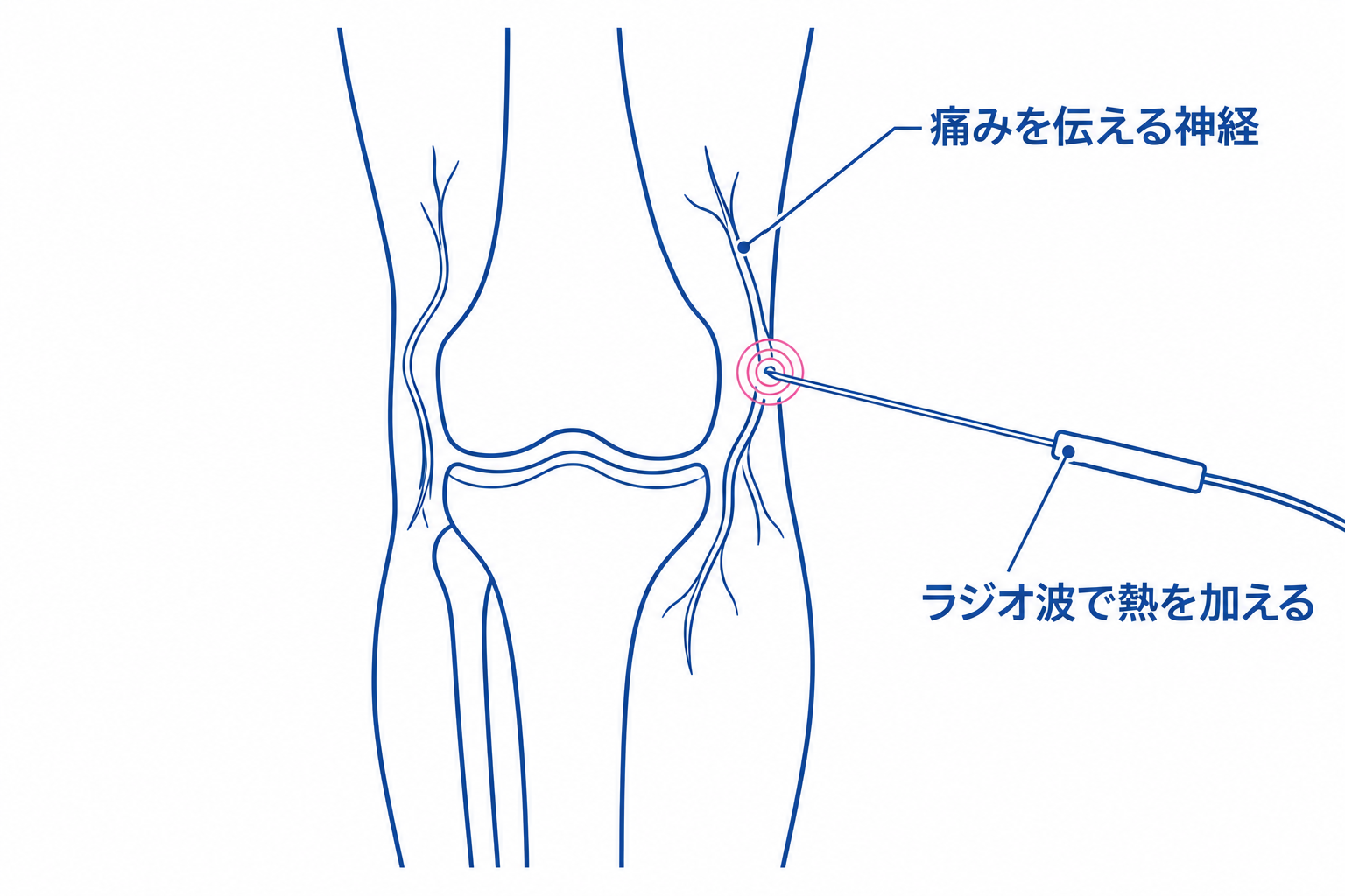 膝の周りにある痛みを伝える神経に、細い電極を近づけて熱を加える様子を簡略化した図